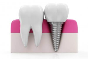 how do dental implants work