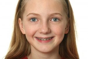 does my child need braces?