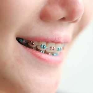 different colour braces