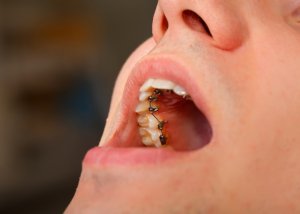 lingual braces behind teeth vs Invisalign