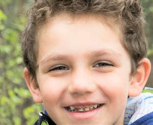 Child with rotten teeth