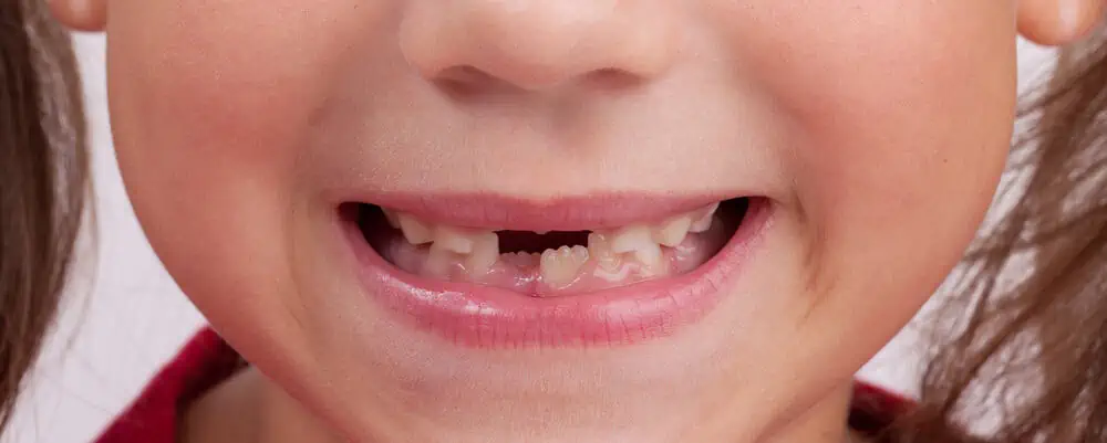 A child with several missing milk teeth