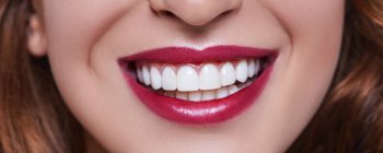 dental veneers