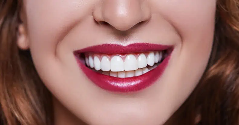 dental veneers