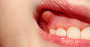 Cracked/Broken/Chipped Tooth Repair, Treatment & Pain Relief