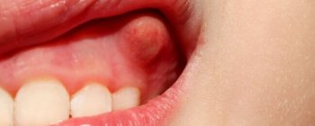 child tooth abscess picture