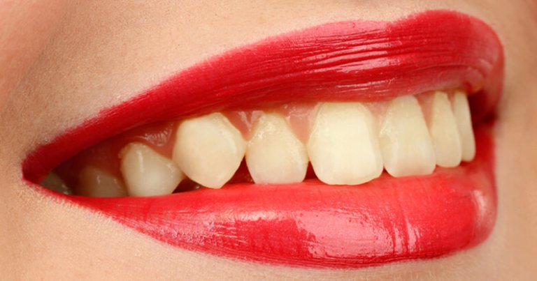 Why Are My Teeth See Through? A Guide To Translucent Teeth. - Why Are My Teeth See Through At The Tips