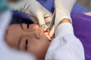 child tooth extraction