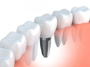 dental implant free