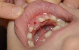 Blood clot after tooth removed