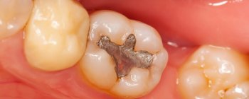 are amalgam fillings safe