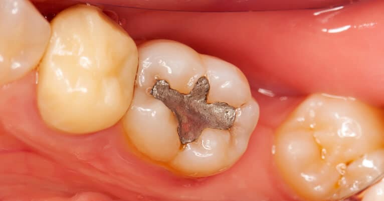 are amalgam fillings safe