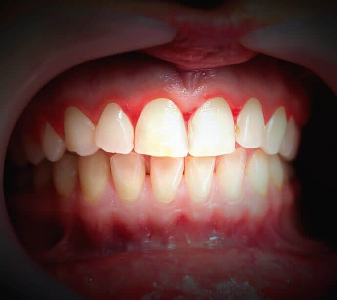 How to Stop Bleeding Gums? Guide to Causes and Treatments