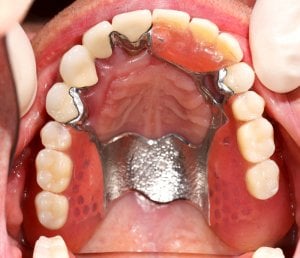 chrome metal dentures picture