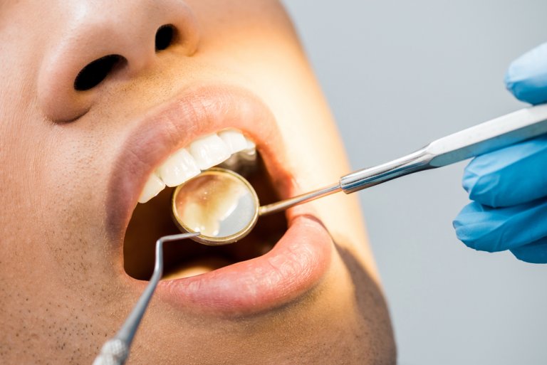 Tooth Filling Costs, Types, Procedure and What to Expect