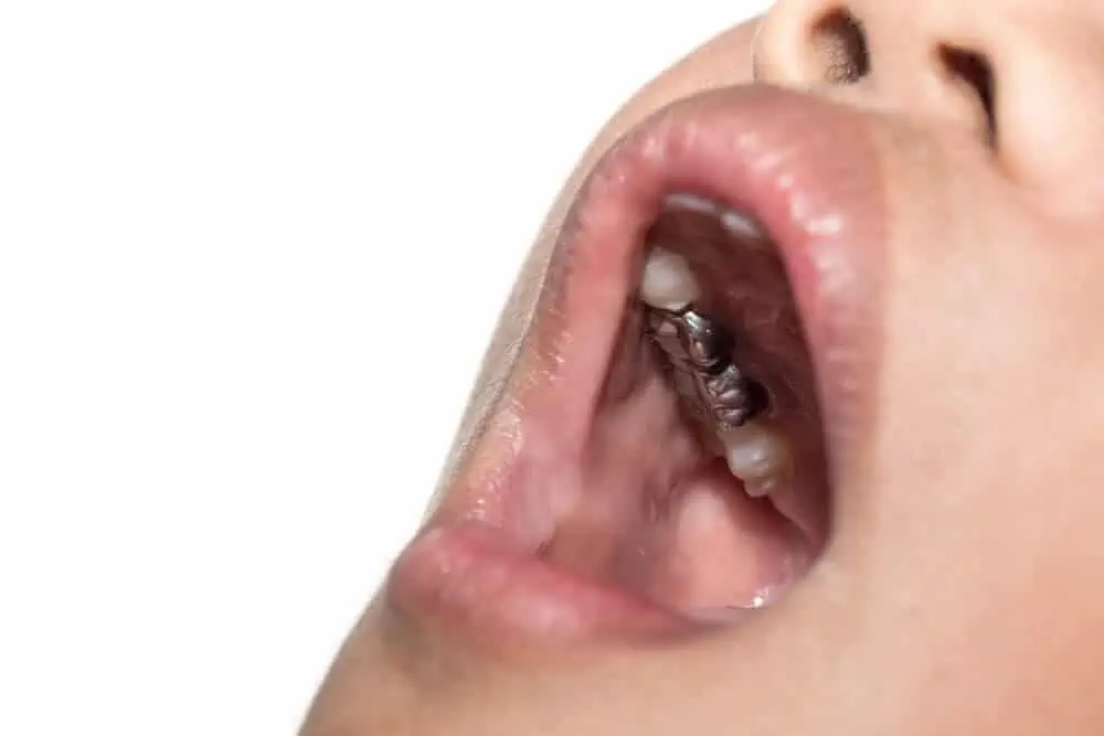 Dental Bridge Costs, Types and More (UK Tooth Bridge Guide)