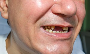 man with missing teeth