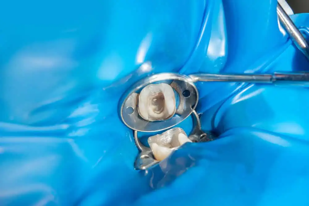 Are Amalgam Fillings Safe? White vs. Silver, Filling Removal