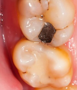 amalgam and composite