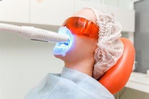 costo dello sbiancamento dei denti laser