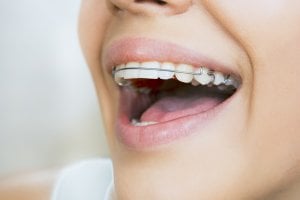 how to keep teeth straight