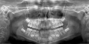 baby teeth x-ray