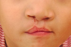 cleft lip after surgery