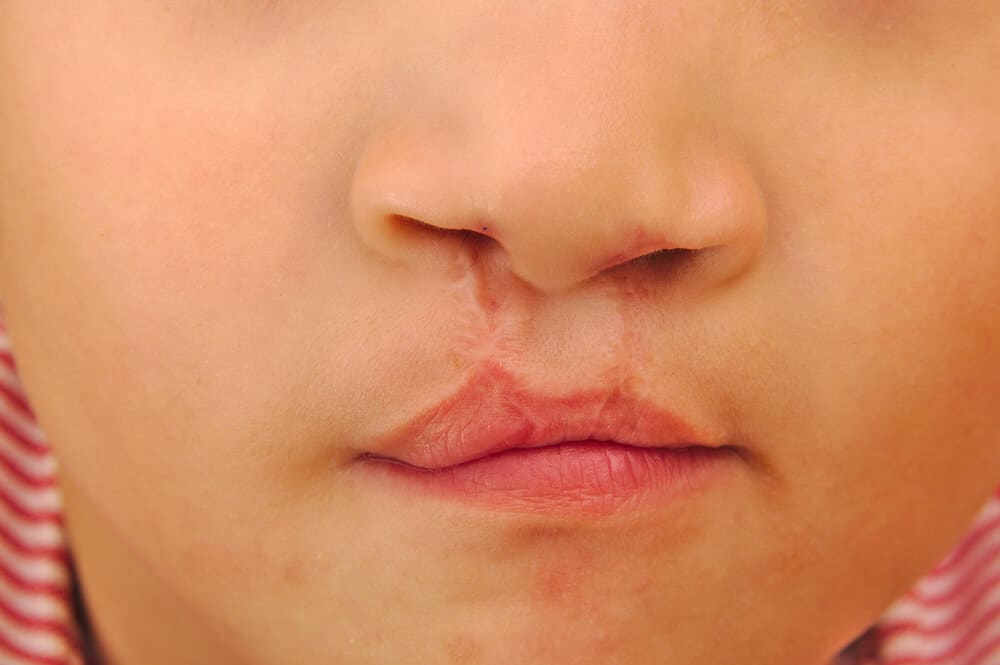 Cleft Palate and Cleft Lip Causes, Treatments, Surgery