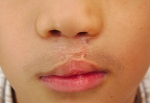cleft lip problems