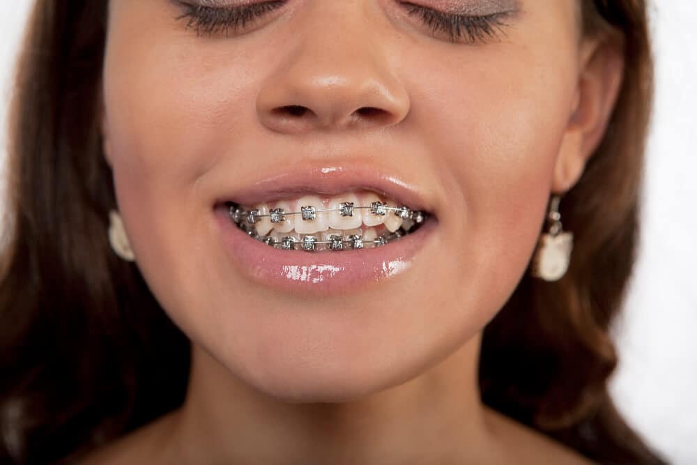 Crossbite Treatment in Adults & Kids Braces, Surgery, Costs