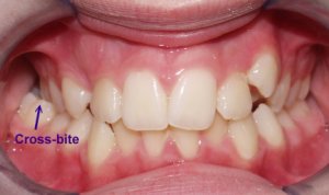 what is a crossbite teeth