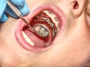 jaw expander