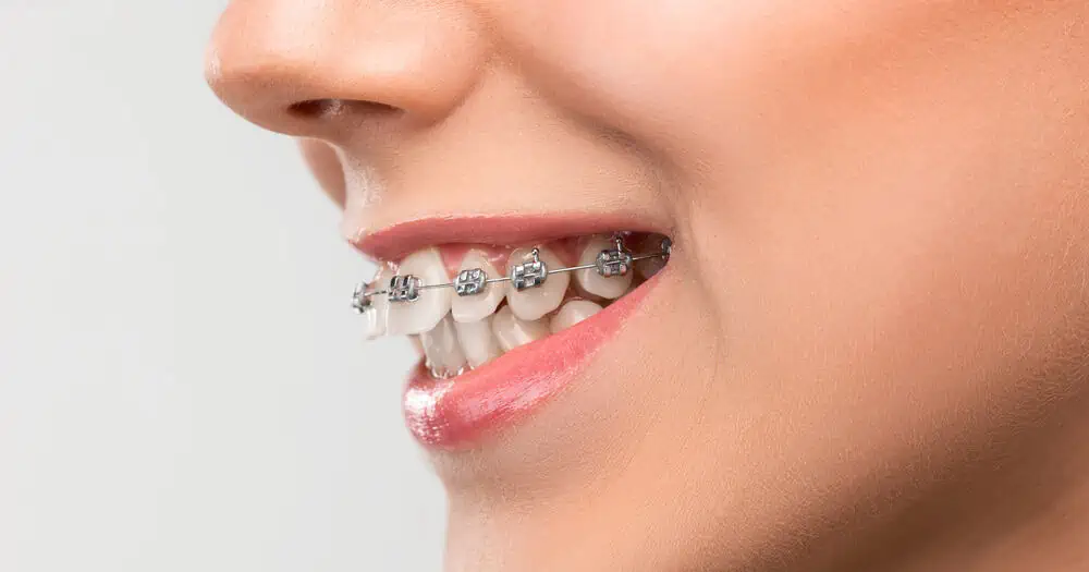 overbite teeth braces