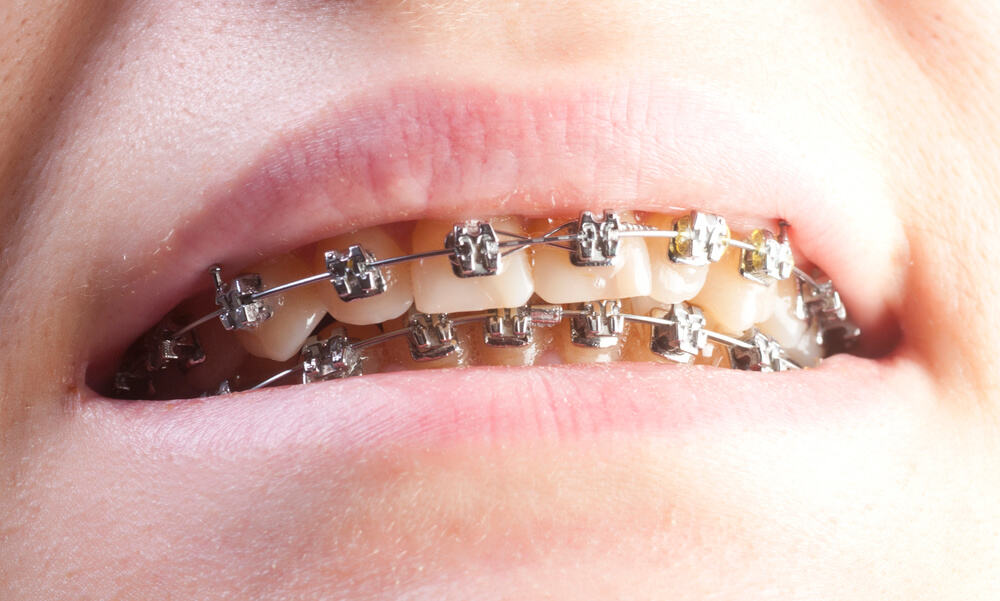 What is Overbite & How Do You Correct It Braces or Surgery?