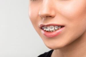 overbite teeth with braces