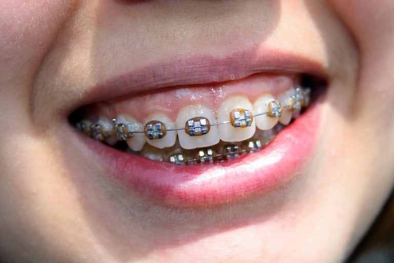 What Is Overbite And How Do You Correct It Braces Or Surgery