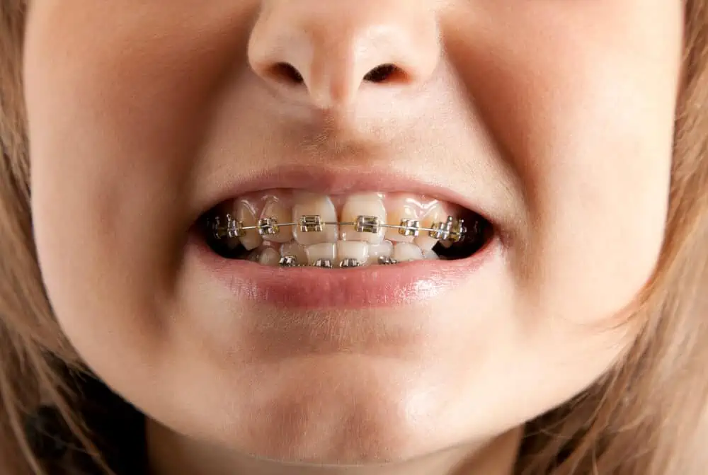 What is Underbite & How Do You Correct It Braces? Surgery?