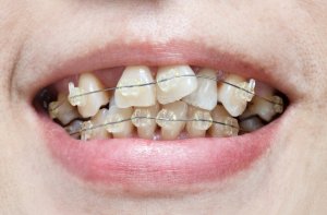 braces on crooked teeth
