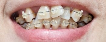 braces on crooked teeth