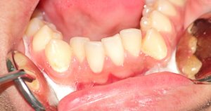 overcrowded lower teeth