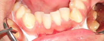 crowded lower teeth