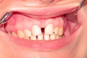 large gap between front teeth