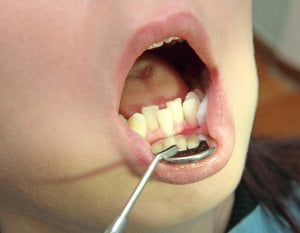 child NHS charges braces