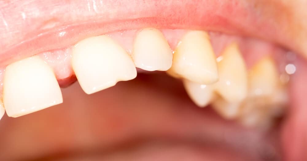 diastema teeth gap