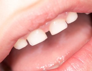 gaps in baby teeth