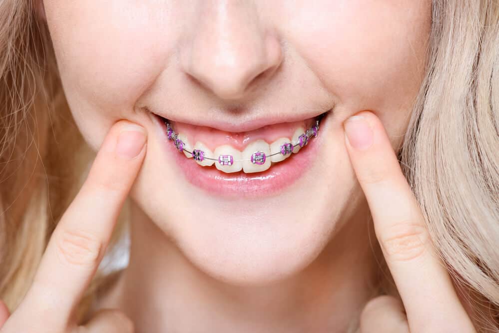 Teeth Straightening Costs &amp; Options With or Without Braces
