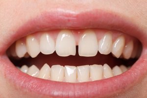 fill gaps in teeth