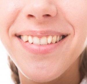 how to straighten teeth