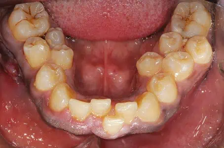 Hyperdontia: Causes of Extra Teeth & Possible Treatments