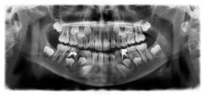 baby teeth xray